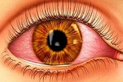 Инфекционное поражение слизистой глаз хламидиями