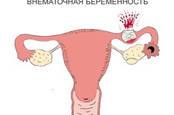 Внематочная беременность - причина коричневых выделений из влагалища