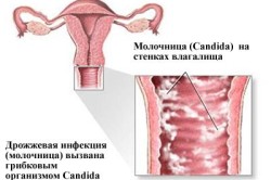 Молочница как причина жжения после мочеиспускания у женщин