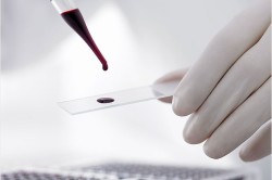 Серологическое исследование крови для диагностики заболевания