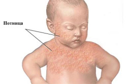 Потница у ребенка как причина сыпи в области паха
