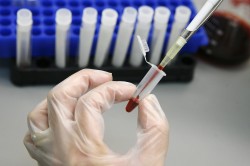Лабораторная диагностика крови на ВИЧ