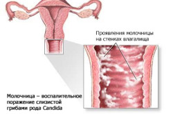 Схема молочницы во время беременности