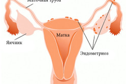 Эндометриоз - одна из причин боли во время полового акта