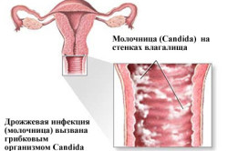 Вагинальный кандидоз при беременности